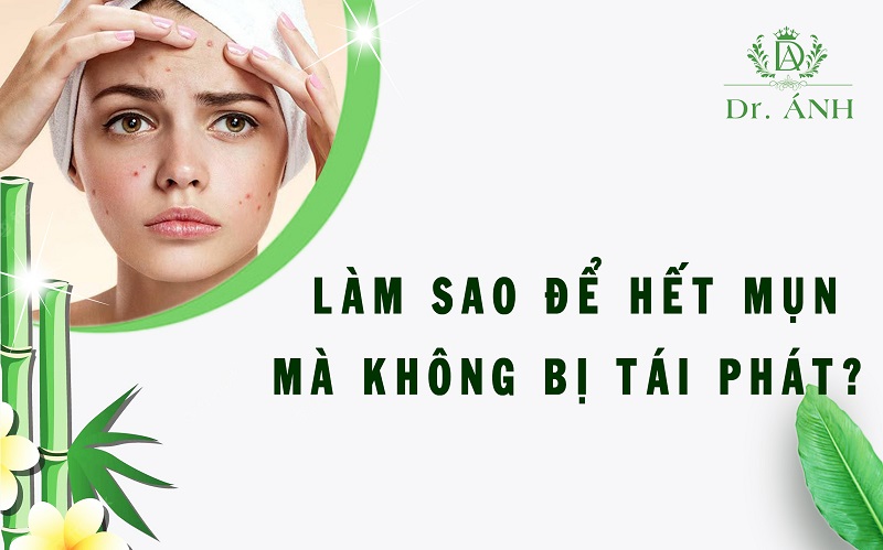 Nguyên nhân da bị nổi mụn và những lưu ý để hết mụn mà không bị tái phát