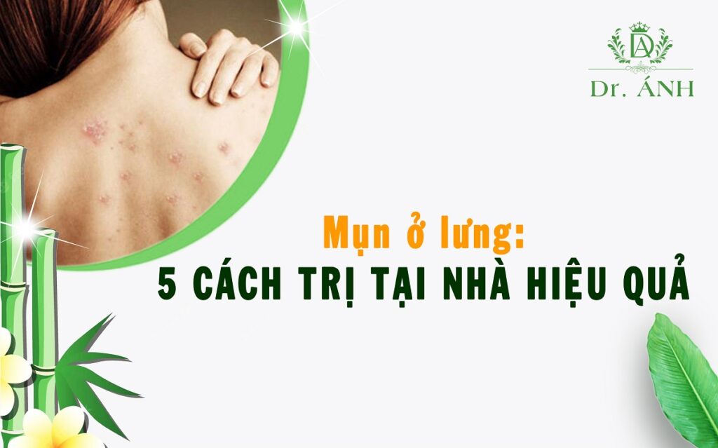 Mụn ở lưng: 5 cách trị tại nhà hiệu quả