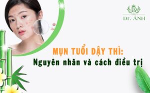 Mụn tuổi dậy thì: Nguyên nhân và cách điều trị dứt điểm